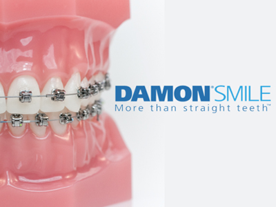 Damon® Braces